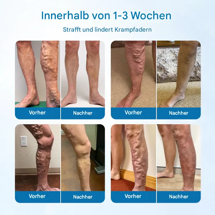 Timilk® VeinGuard Herbal Spray-✅ Clinically proven to eliminate varicose veins in just 7 days!